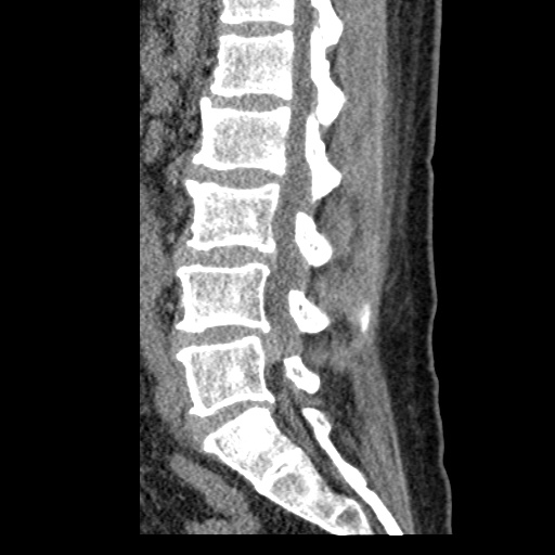 Lumbar disc extrusion on CT | Image | Radiopaedia.org