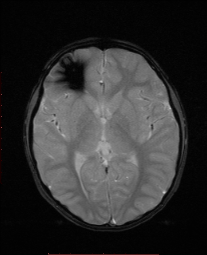 Cerebral Cavernous Venous Malformations Image Radiopaedia Org Hot Sex Picture 4942