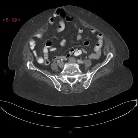 Small Bowel Lipoma Radiology Case Radiopaedia Org