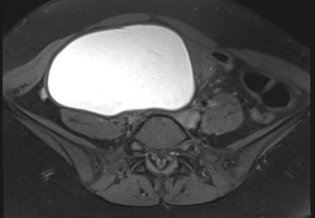 case study 65 endometriosis