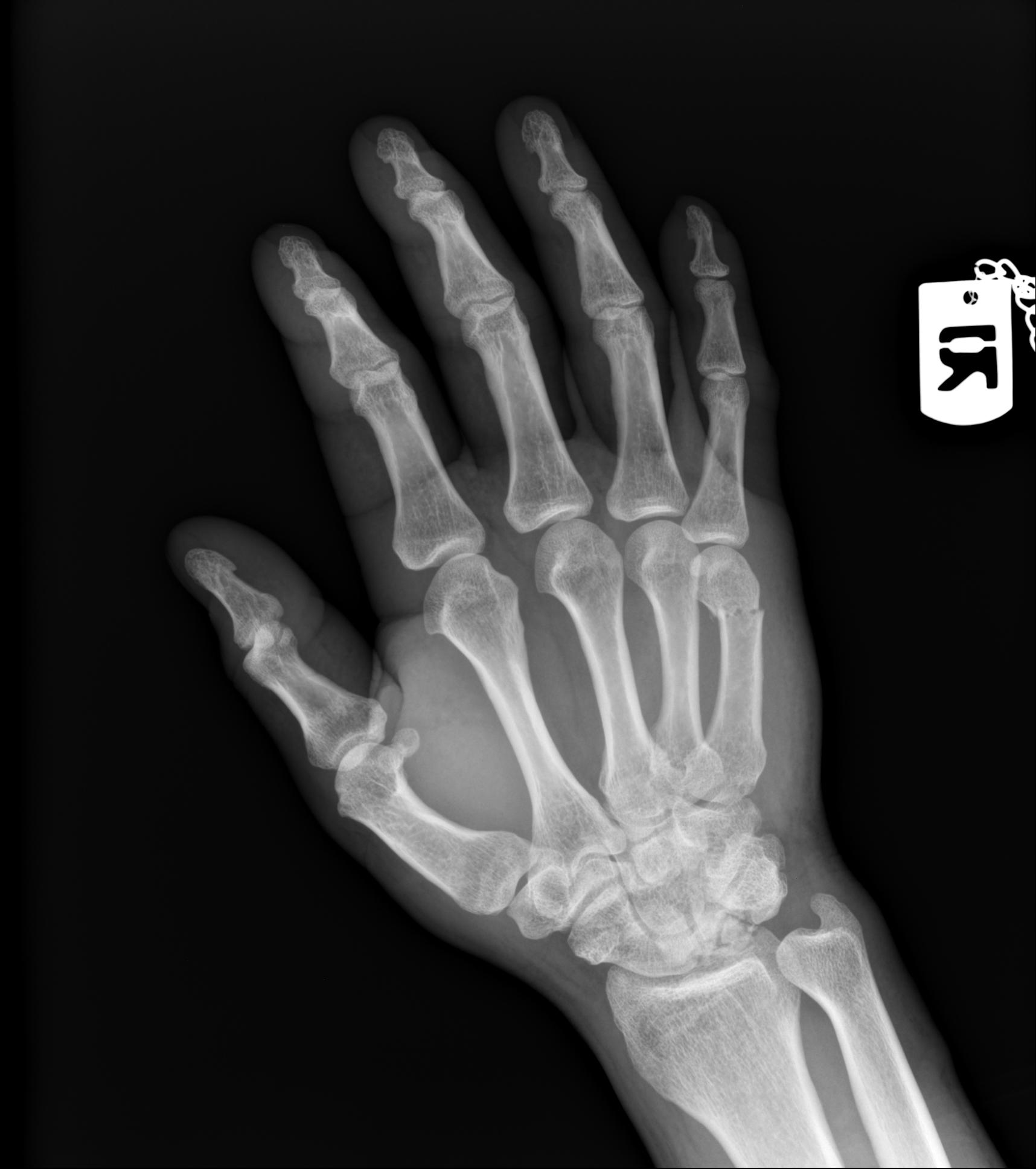 Boxer Fracture Image Radiopaedia Org