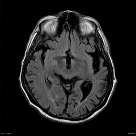 Fronto-temporal lobar degeneration - logopaenic variant primary ...