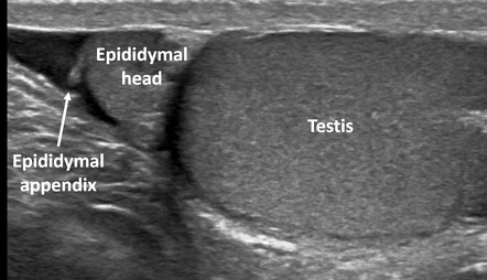 Epididymal appendix | Radiology Case | Radiopaedia.org