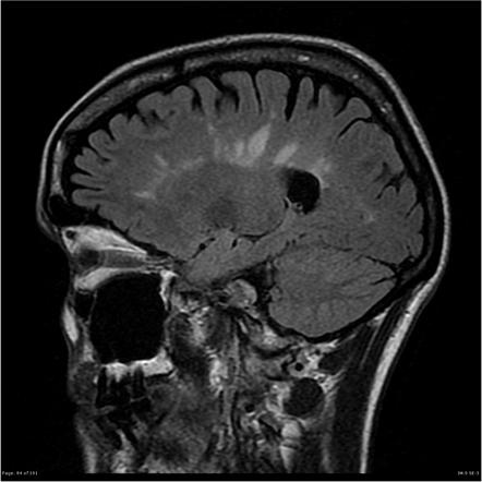 Multiple sclerosis | Radiology Reference Article | Radiopaedia.org