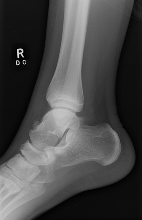 Exostosis of the talus | Image | Radiopaedia.org