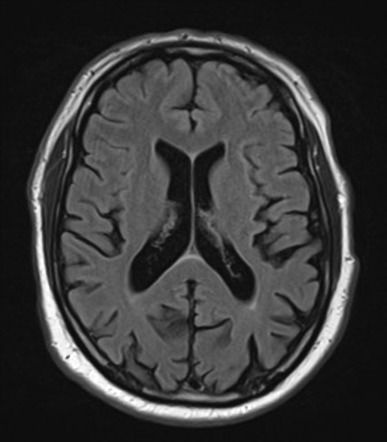 Tau dementia | Image | Radiopaedia.org