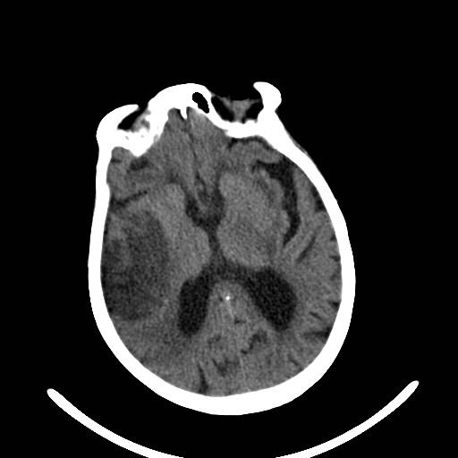 Fat embolism causing MCA infarct | Image | Radiopaedia.org