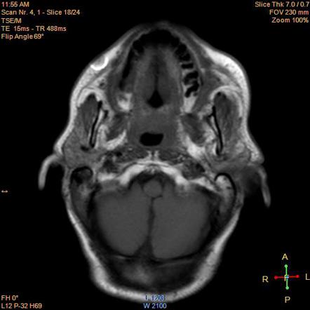 Nasopharyngeal Carcinoma | Radiology Case | Radiopaedia.org