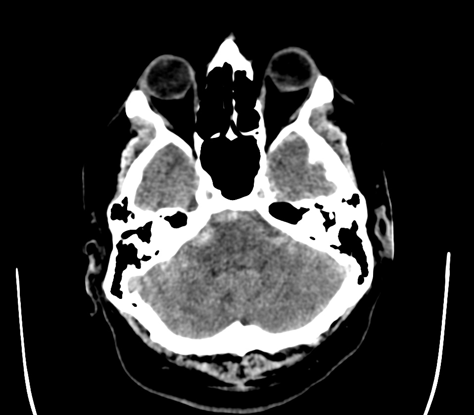 Rubinstein-Taybi syndrome - wikidoc