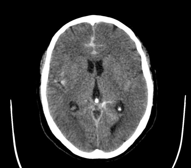 Rubinstein-Taybi syndrome - wikidoc