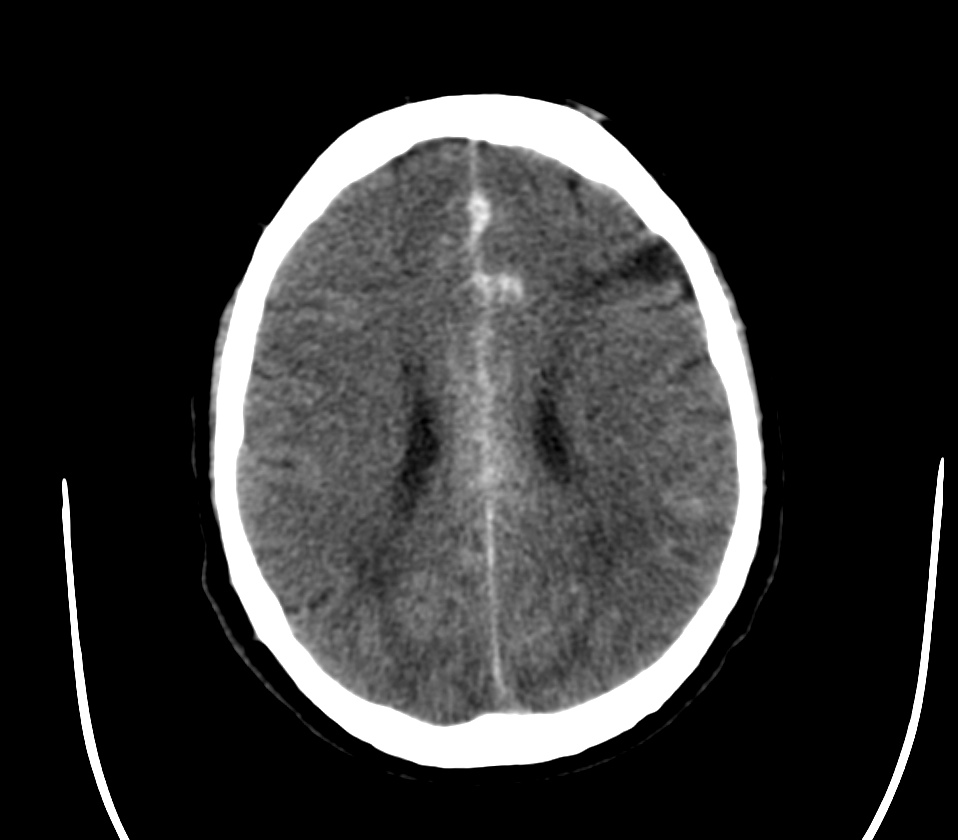 Rubinstein-Taybi syndrome - wikidoc