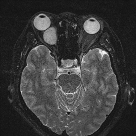 Cavernous Venous Malformation