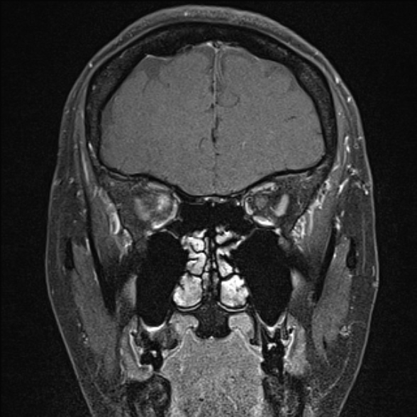 Orbital Cavernous Hemangioma Image