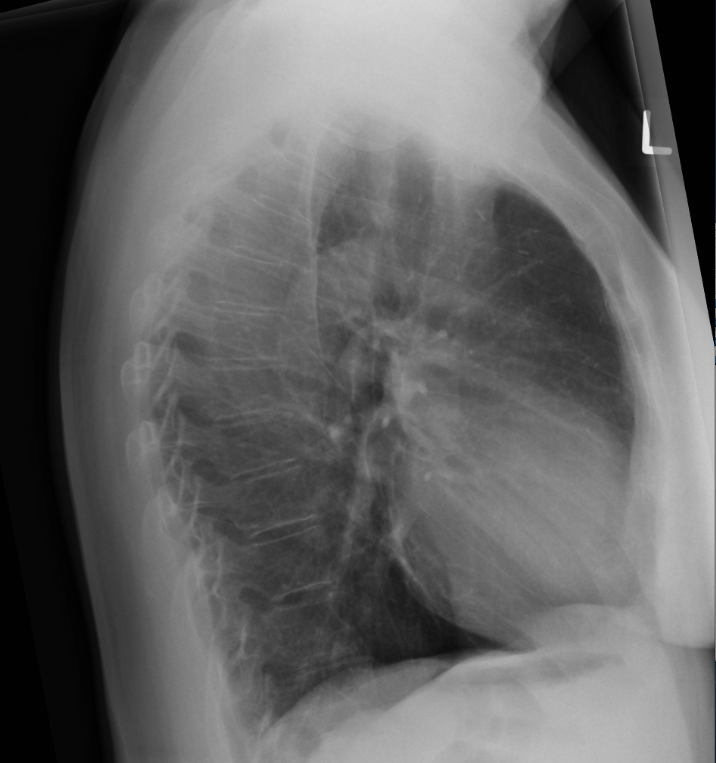 Previous breast cancer - axillary surgical clips (chest x-ray) | Image ...