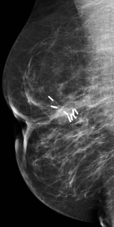 Surgical scar of the breast | Radiology Case | Radiopaedia.org