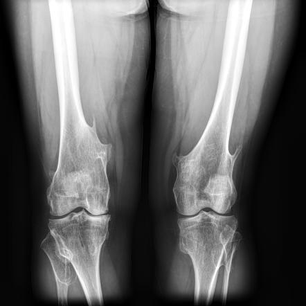 hereditary multiple exostoses case study