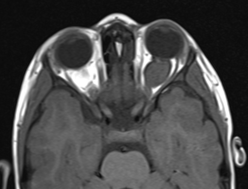 Optic Nerve Glioma Image Radiopaedia