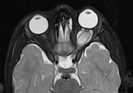 Optic nerve glioma | Image | Radiopaedia.org