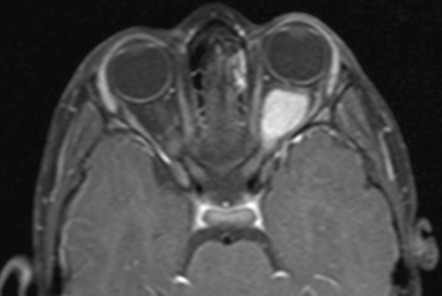 Optic nerve glioma | Radiology Case | Radiopaedia.org