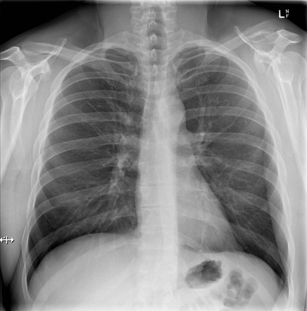 Cannula mimicking foreign body | Radiology Case | Radiopaedia.org