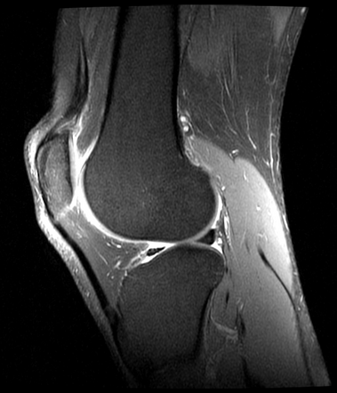 Bucket handle meniscal tear | Radiology Case | Radiopaedia.org