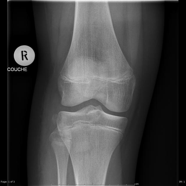 Segond fracture | Radiology Reference Article | Radiopaedia.org