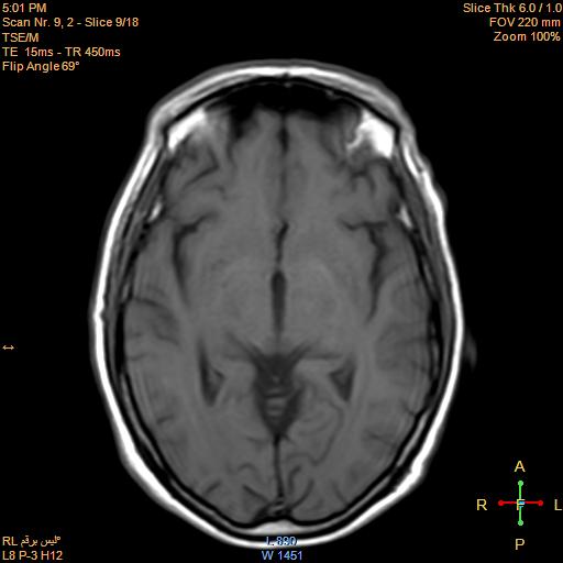 Central Pontine Myelinolysis Image Radiopaedia Org