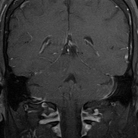 Cerebellar Infarction | Image | Radiopaedia.org