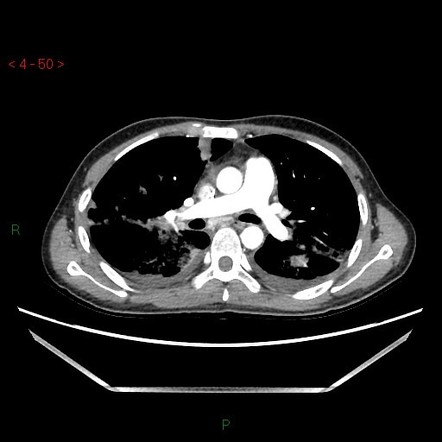 Lung abscesses | Radiology Case | Radiopaedia.org