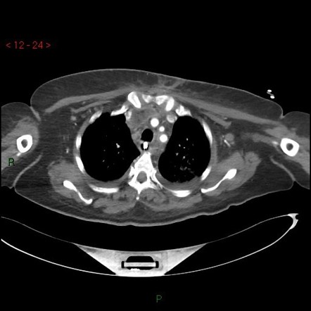 Mediastinitis | Radiology Reference Article | Radiopaedia.org