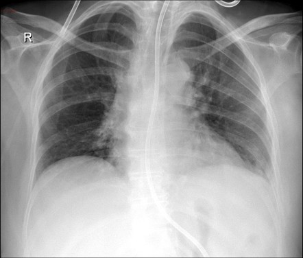 Mediastinitis (acute) | Image | Radiopaedia.org