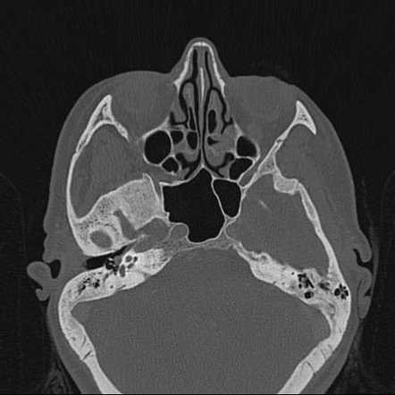 Glomus tympanicum paraganglioma | Radiology Reference Article ...