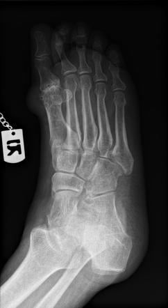 Tophaceous Gout Image Radiopaedia Org