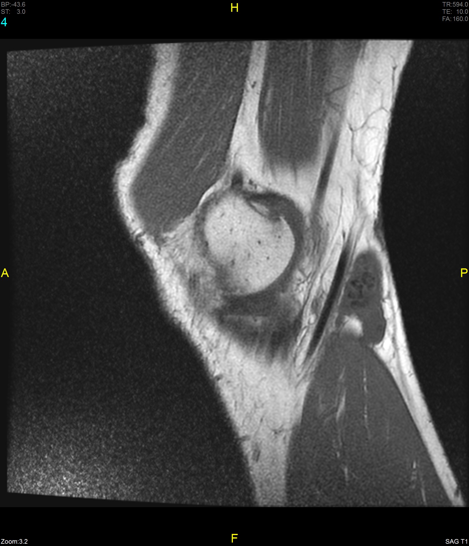 Synovial osteochondromatosis of the gastrocnemius semimembranosus-bursa ...