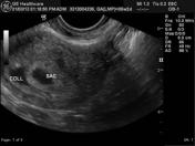 Subchorionic Hematoma Size Chart