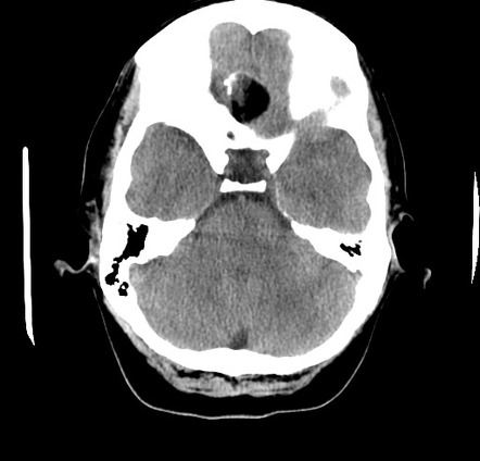 Intracranial dermoid cyst | Radiology Case | Radiopaedia.org