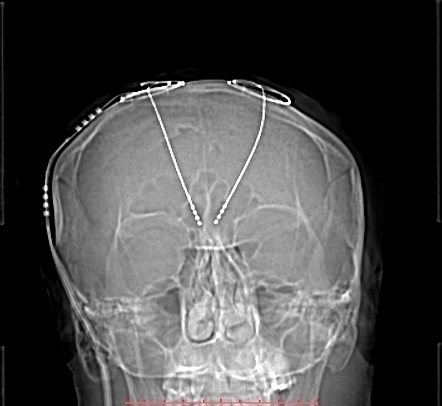 Deep brain stimulation | Radiology Reference Article | Radiopaedia.org