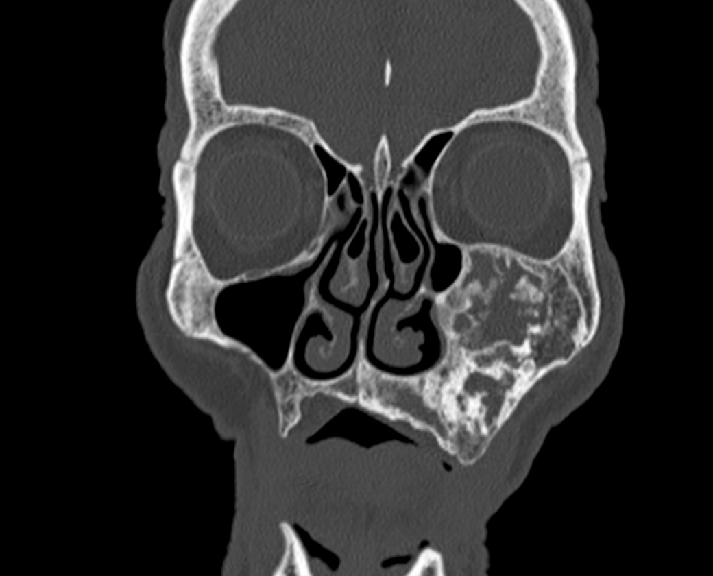 Ossifying Fibroma Maxillary Sinus