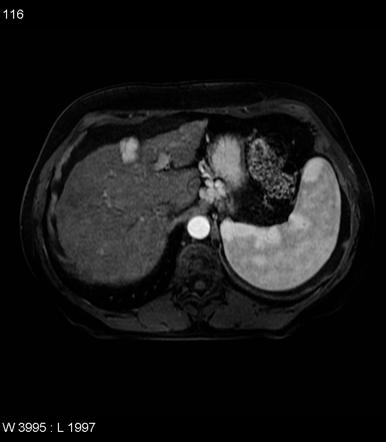 Hypervascular Liver Lesions Radiology Reference Article Radiopaedia Org