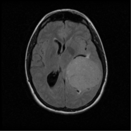 Meningioma | Image | Radiopaedia.org