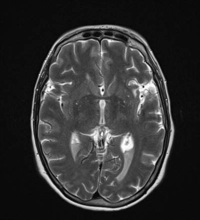 Pyogenic ventriculitis | Image | Radiopaedia.org