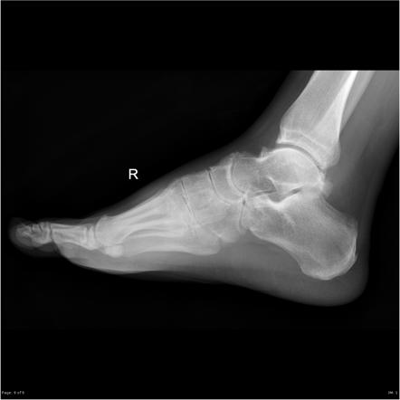 Tophaceous gout | Image | Radiopaedia.org