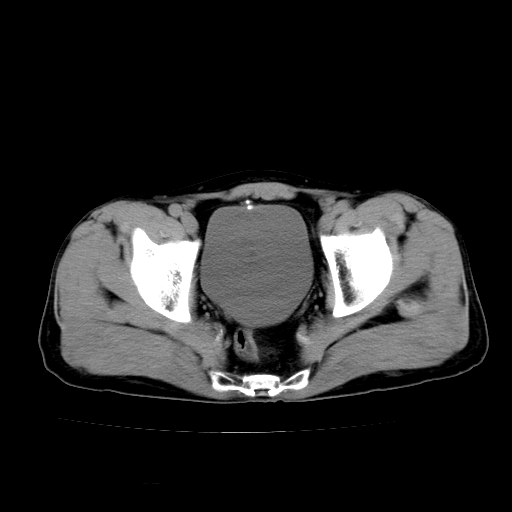 Calcified Urachal Remnant With Vesicourachal Diverticulum Stone Image 1301