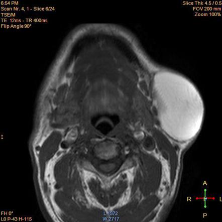 Lipomatous lesions | Radiology Reference Article | Radiopaedia.org