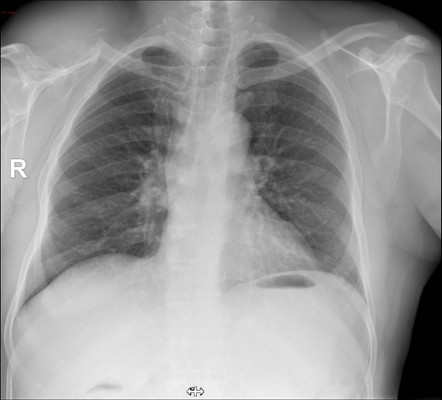 Thyroid cancer metastasis to bone | Radiology Case | Radiopaedia.org