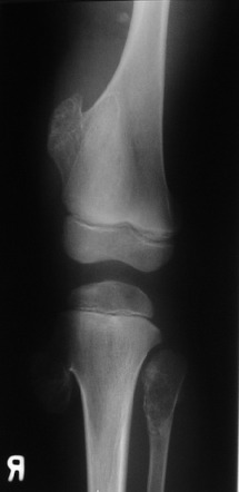 hereditary multiple exostoses case study