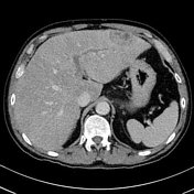 Pylephlebitis | Radiology Reference Article | Radiopaedia.org