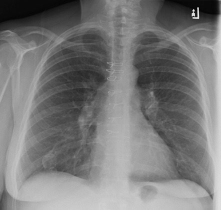 Breast fat necrosis on chest radiograph | Radiology Case | Radiopaedia.org