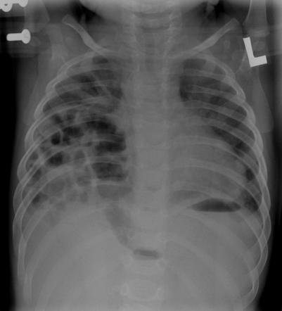 Congenital Diaphragmatic Hernia Radiology Reference Article Radiopaedia Org