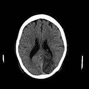 posterior cerebral artery distribution